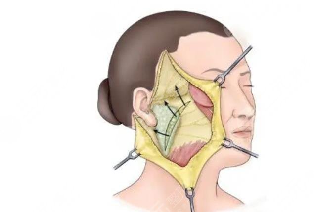 双燕尾拉皮手术多少钱