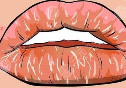 唇部老化的原因有哪些？唇部老化如何改良？