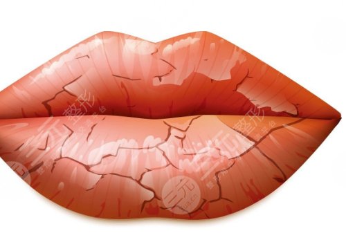 唇部老化的原因有哪些？唇部老化如何改良？
