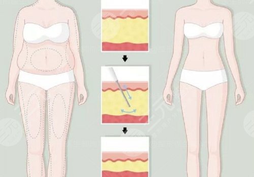 身体塑形能达到减肥的效果吗？
