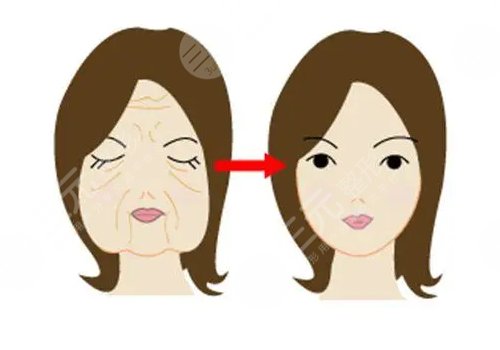 韧带提升和拉皮的区别是什么？