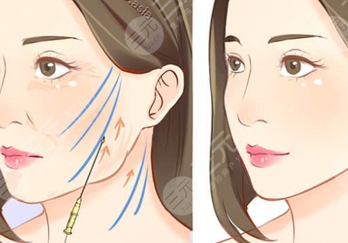 韧带提升和拉皮的区别是什么？