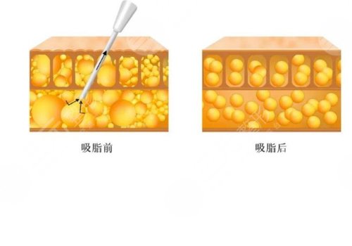 吸脂凹凸不平多久恢复？