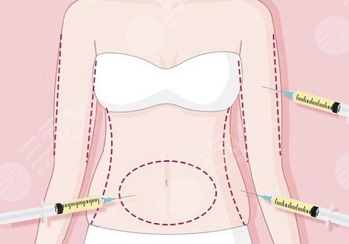 吸脂凹凸不平多久恢复？