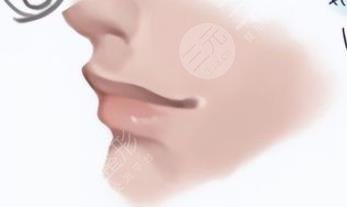 唇部整形