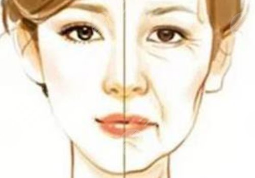 动态纹和静态纹哪个属于真性皱纹?