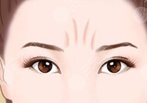 动态纹和静态纹哪个属于真性皱纹?