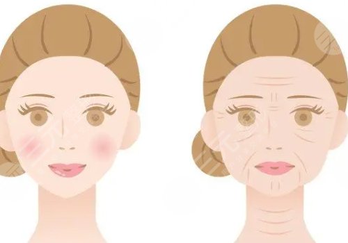 动态纹和静态纹哪个属于真性皱纹?