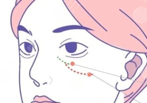 双美胶原蛋白填充泪沟能维持多久?