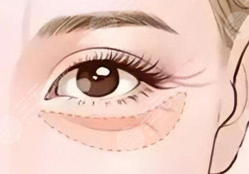 双美胶原蛋白填充泪沟能维持多久?