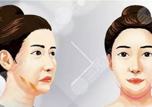 下颌缘提升有什么效果？