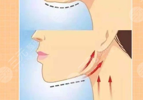 下颌缘提升有什么效果？