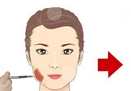 下颌缘提升有什么效果？