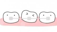 牙整形矫正怎么刷牙？正畸期牙齿护理指南分享！