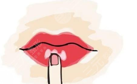 m唇整形一般多久拆线？术前小科普，这3件事你该了解！