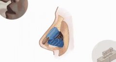 鼻子骨雕整形是什么原理,多少钱?珊瑚骨美鼻指南! 鼻子骨雕整形是什么原理,多少钱?珊瑚骨美鼻指南!