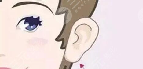耳部整形