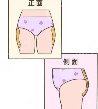 臀部两侧凸起怎么整形？吸脂体雕助你矫正不美臀型！