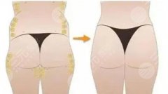 屁股下垂用什么整形？2种手术方案分享，蜜桃美臀打造指南！