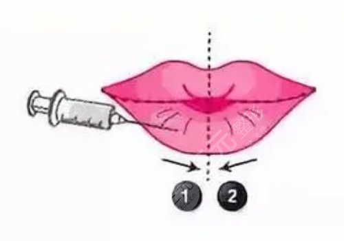 玻尿酸丰唇多久消肿?能维持多久?