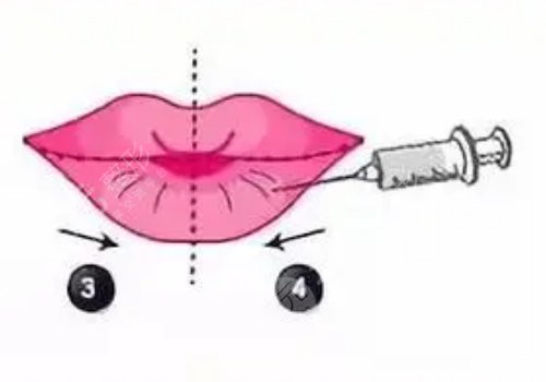 玻尿酸丰唇多久消肿?能维持多久?