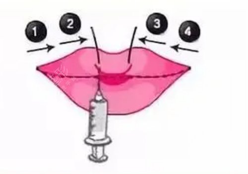 玻尿酸丰唇多久消肿?能维持多久?