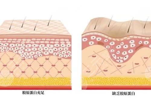 双美胶原蛋白有几种型号？