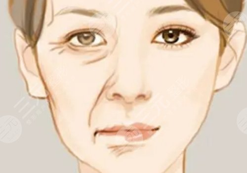 括号纹怎么去掉？怎么形成的？改良方式解读！