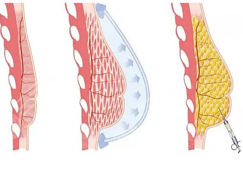 深圳胸部整形医生排名