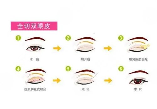 北京304医院割双眼皮怎么样
