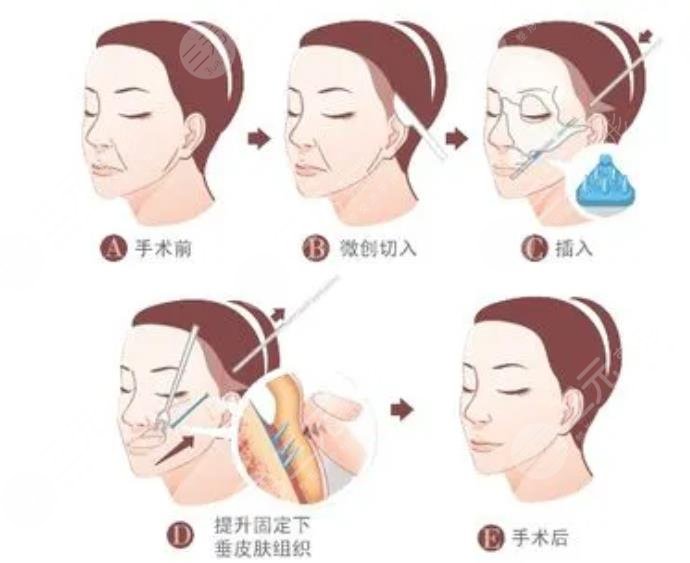 鞍山齐敏医院美容拉皮手术案例