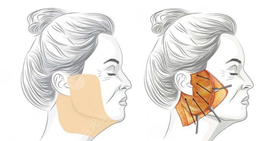 吴佳君医生拉皮真实案例