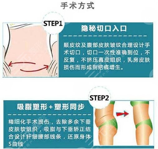 腰腹抽脂腹壁整形恢复期要多久？重塑小蛮腰，这些事你要知道！