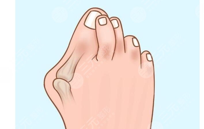 大脚骨怎么缓解比较好?