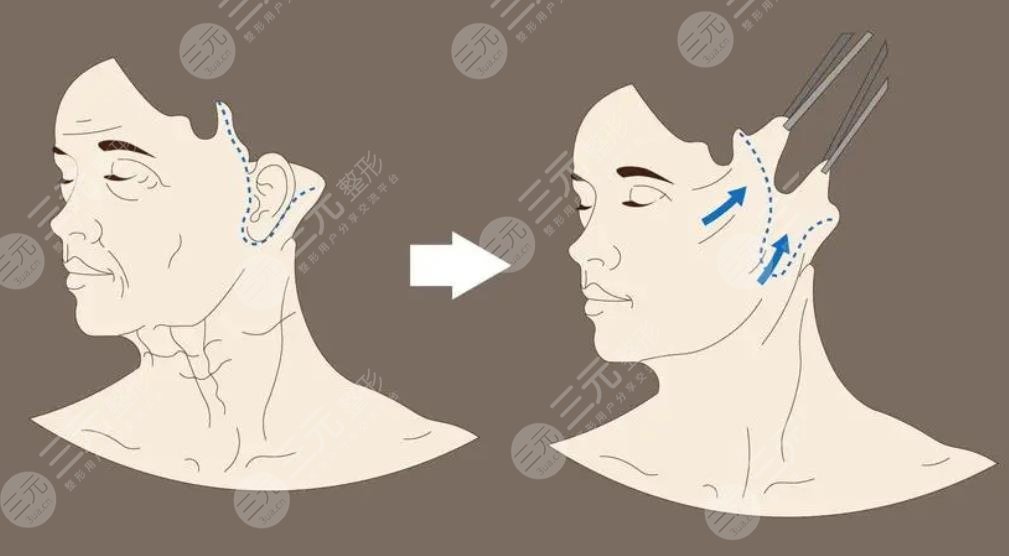 李晓东做pst面部提升案例