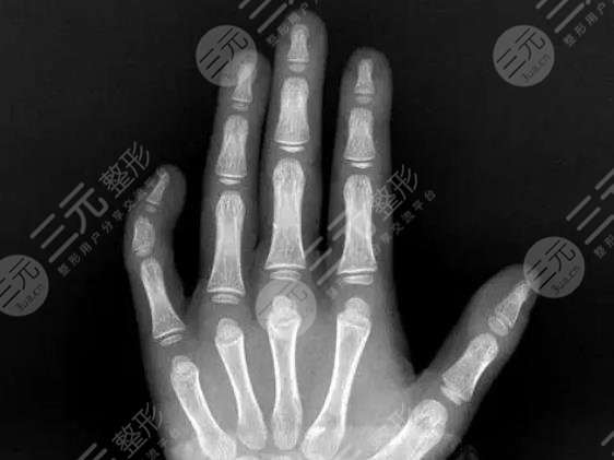 小指弯曲 手指整形 矫正