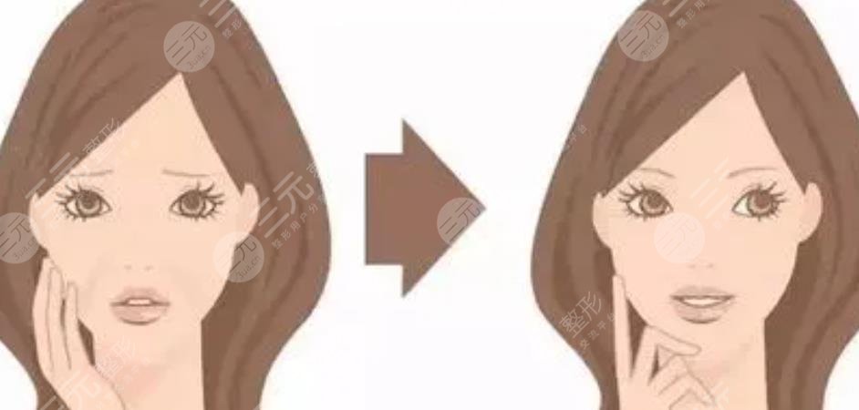 轮廓固定提升