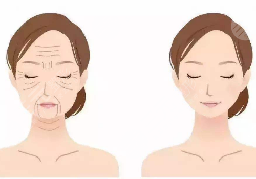 轮廓针一般打几针