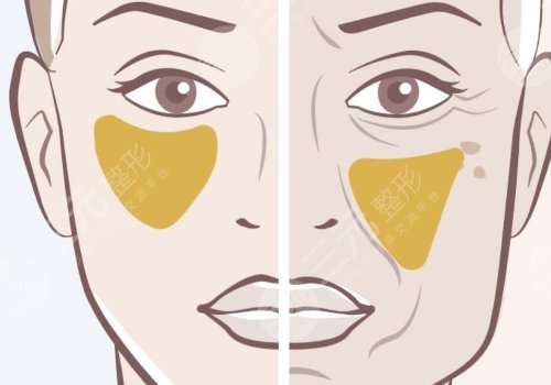 苹果肌断层有啥办法解决？