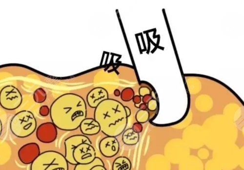 郑楚蓉做脂肪怎么样