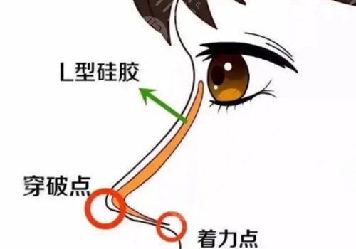 北京彤美整形医院隆鼻技术好不好