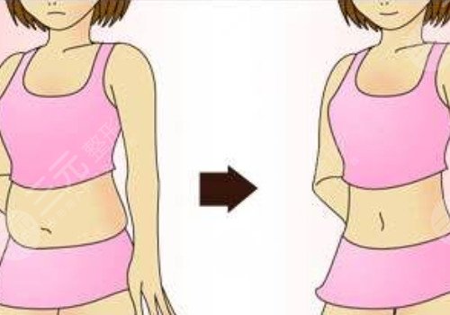 长沙美研抽脂怎么样?