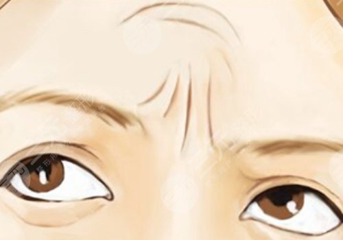 抬头纹去除手术需要多少钱?