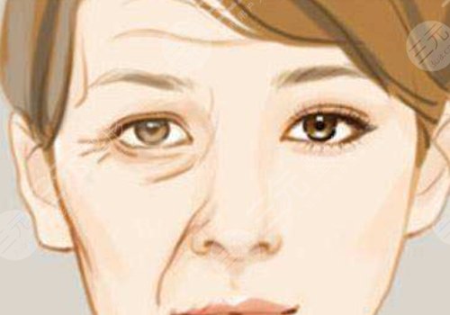 抬头纹去除手术需要多少钱?