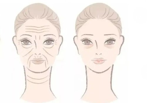 抬头纹去除手术需要多少钱?