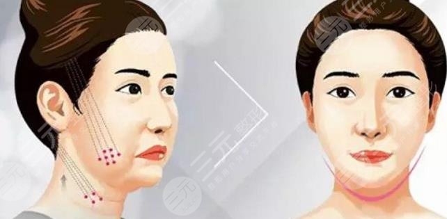 除皱
