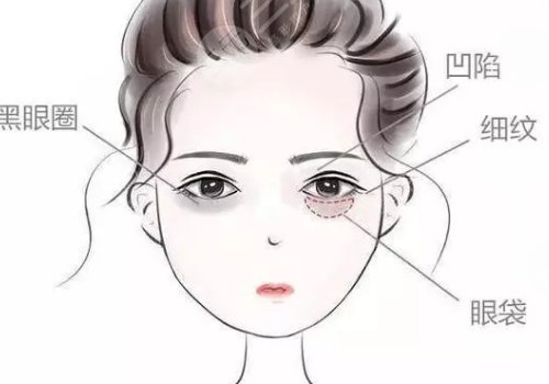 眼窝凹陷用什么填充好？