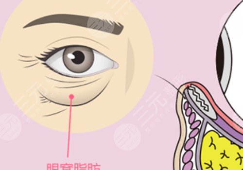 眼窝凹陷用什么填充好？