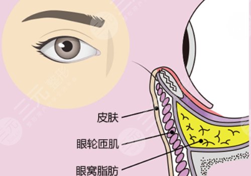 眼窝凹陷用什么填充好？