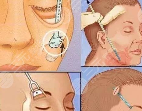 轮廓紧致针